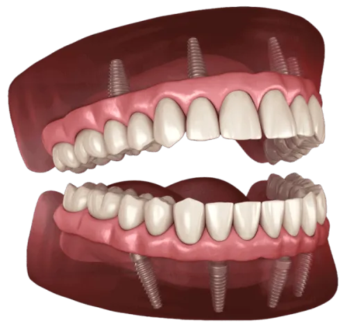 Permanent Zirconia Teeth