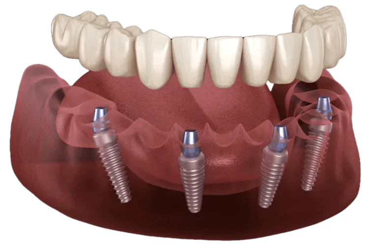 All On 4 Implants