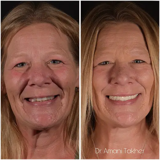 Before After Smiling Face