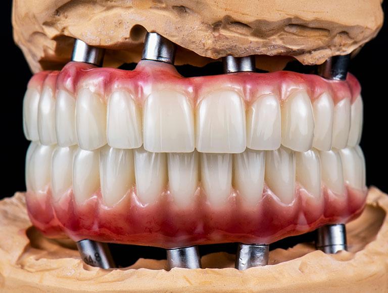 Why Dental Implant Pricing Varies