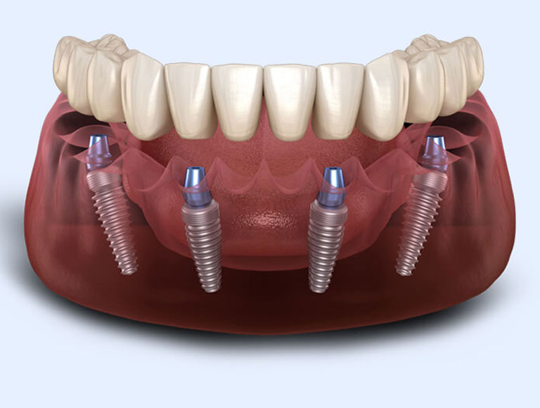 Full-Arch Implant Cost Factors