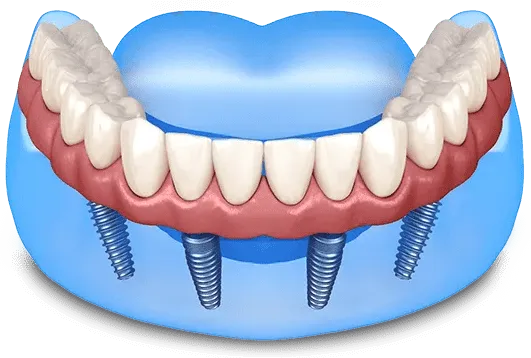 Permanent PMMA Teeth Single Arch