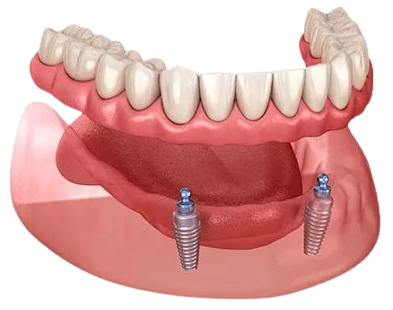 2 Implant Lower Retained Overdentures