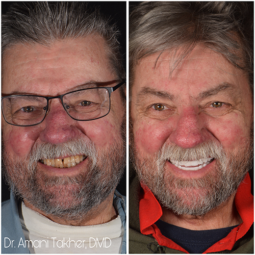 Before After Smiling Face