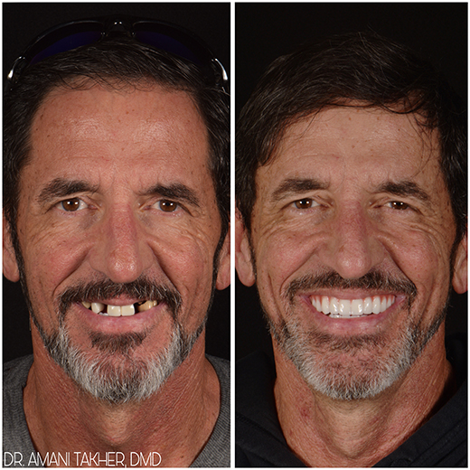 Before After Smiling Face