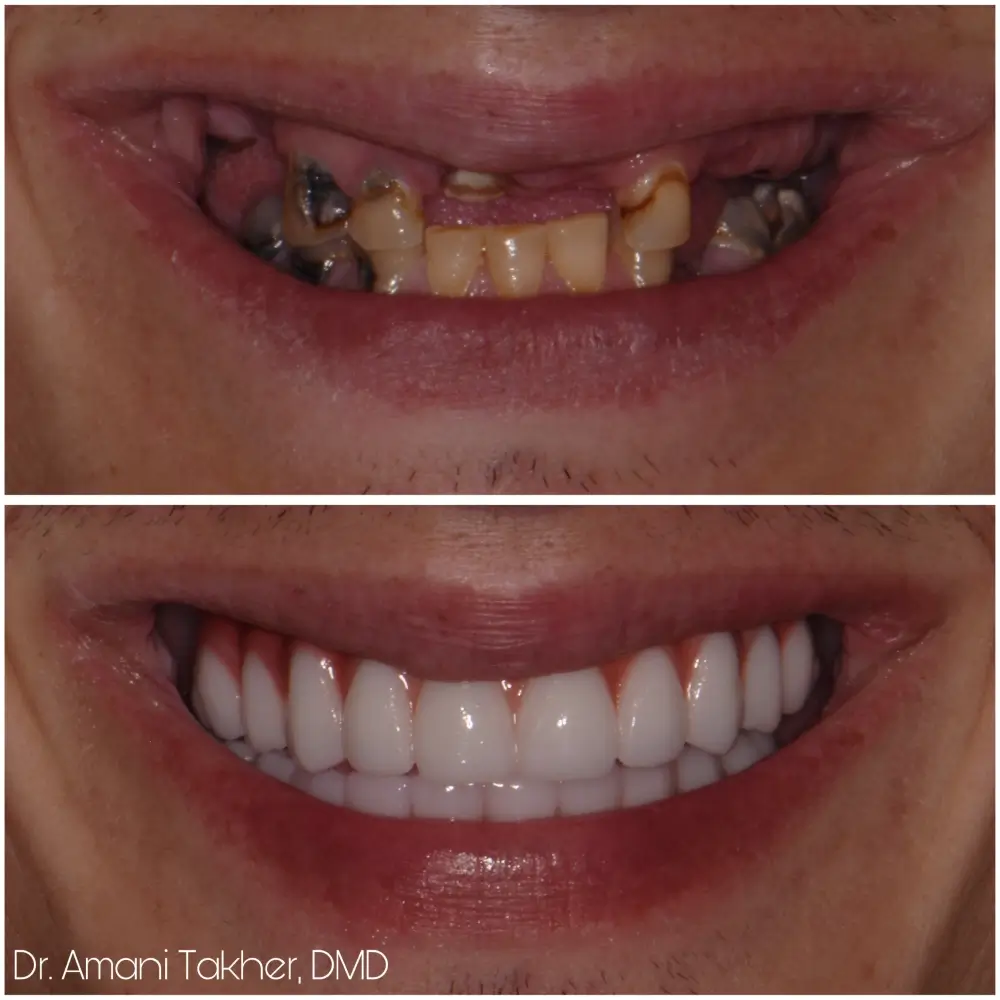 Before After Smiling Face