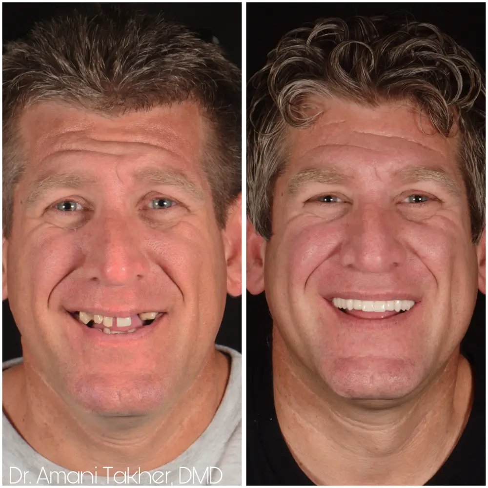 Before After Smiling Face