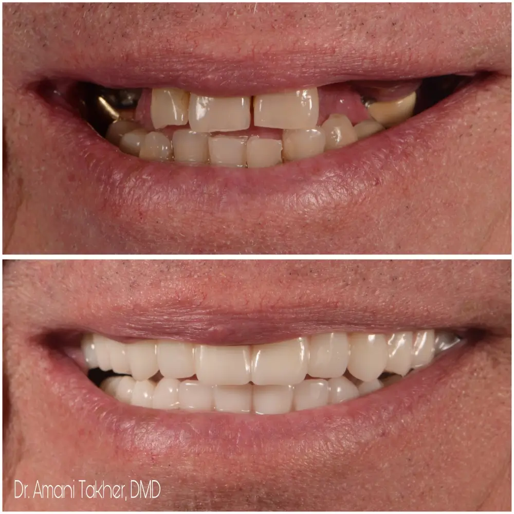 Before After Smiling Face