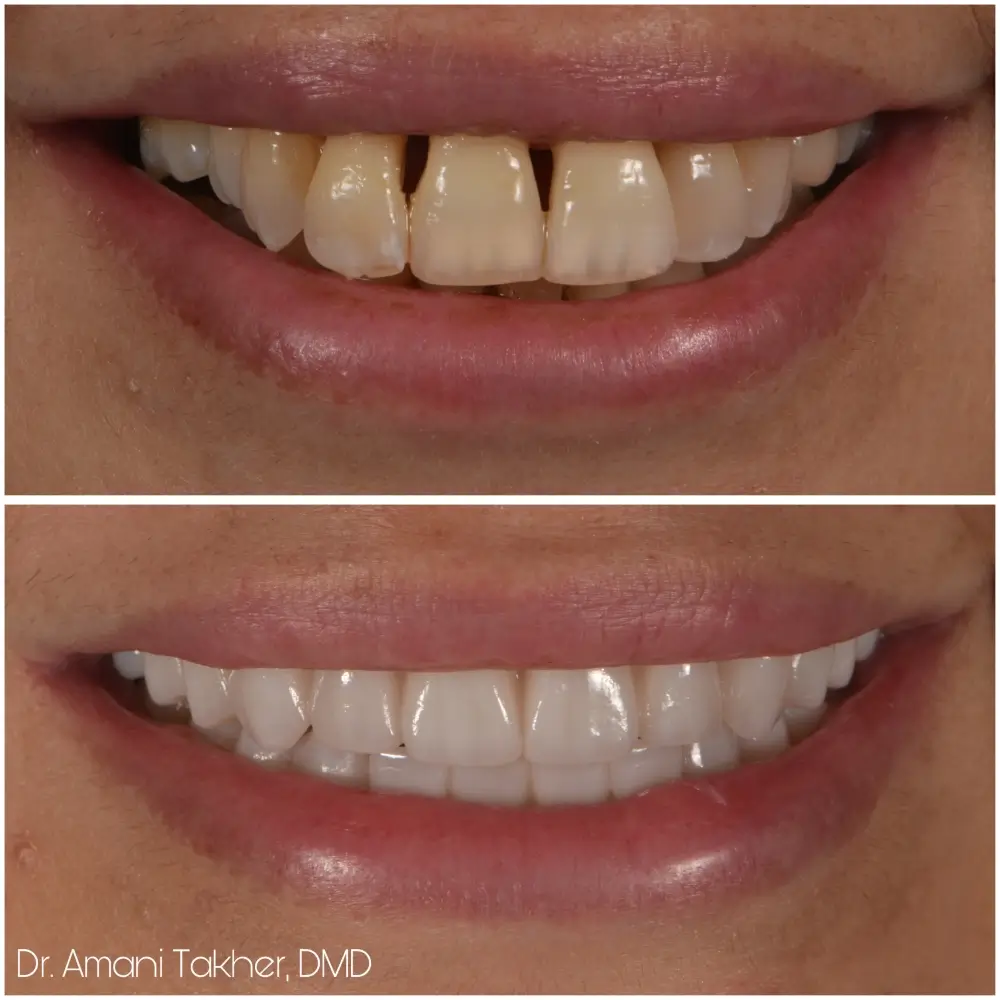 Before After Smiling Face