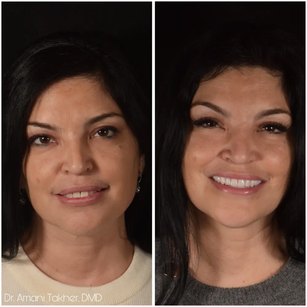 Before After Smiling Face