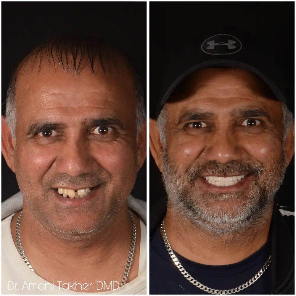 Before After Smiling Face