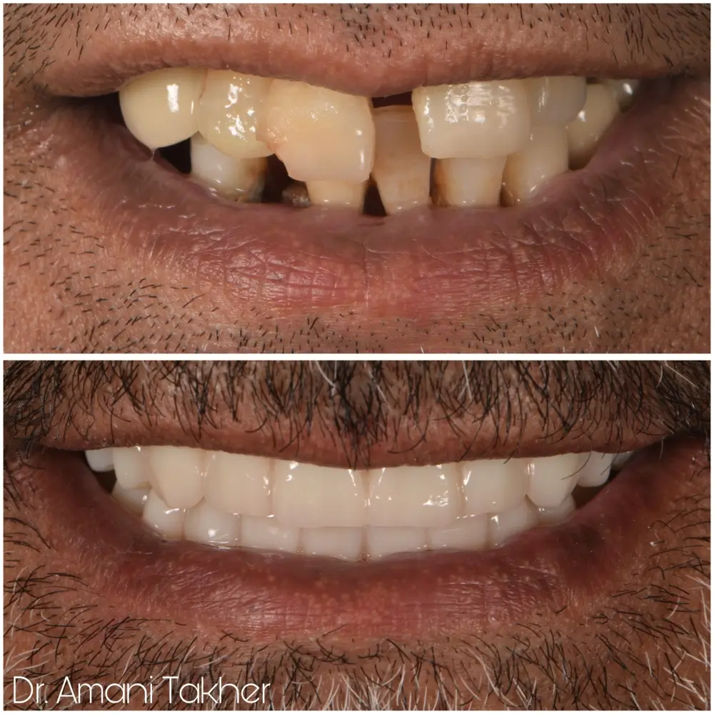 Before After Smiling Face