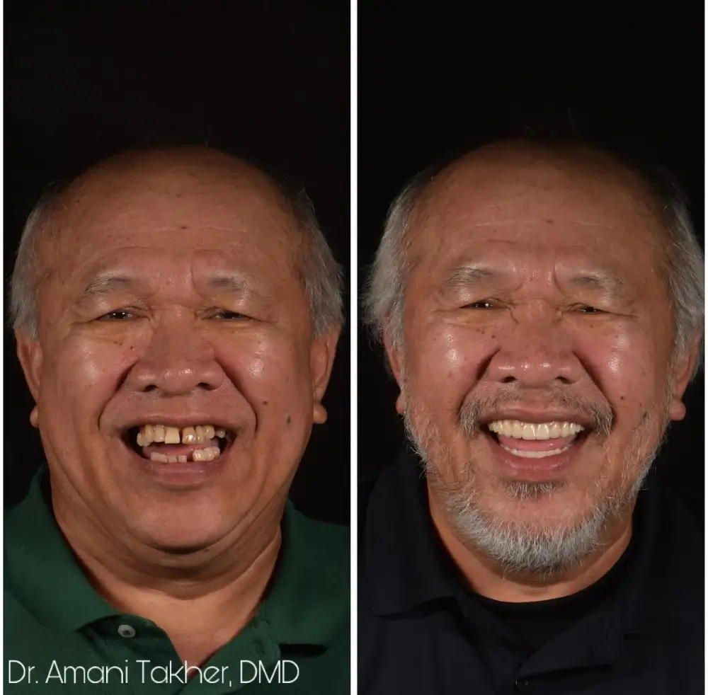Before After Smiling Face