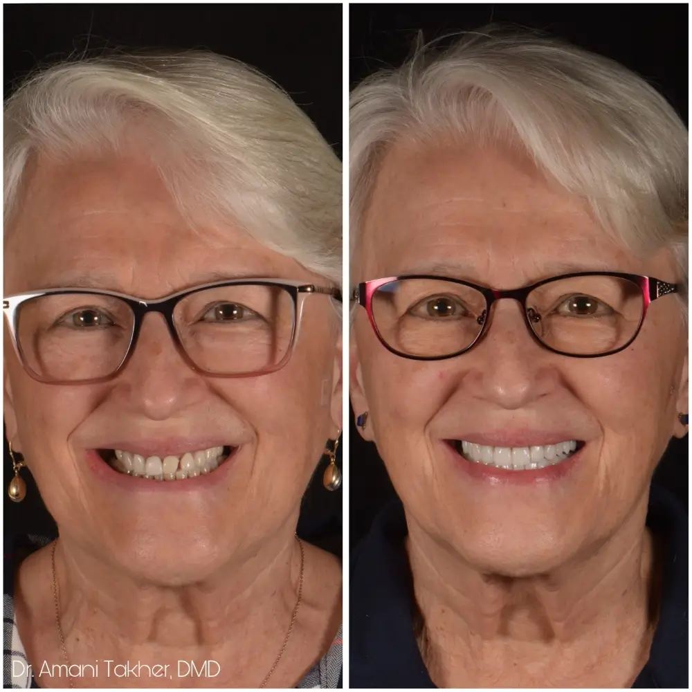 Before After Smiling Face