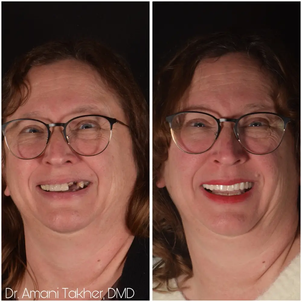 Before After Smiling Face